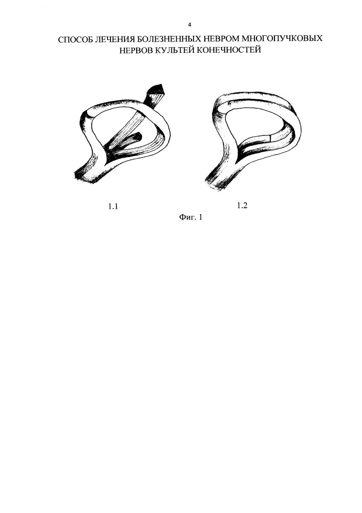 Способ лечения болезненных невром многопучковых нервов культей конечностей (патент 2651689)