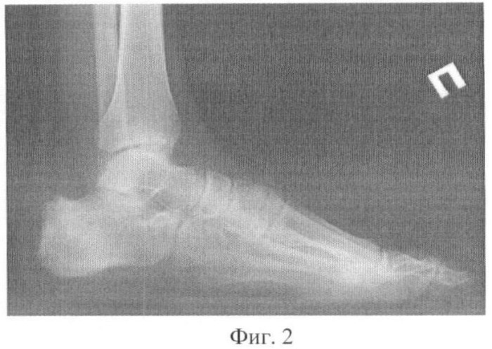 Способ лечения остеомиелита пяточной кости (патент 2407469)