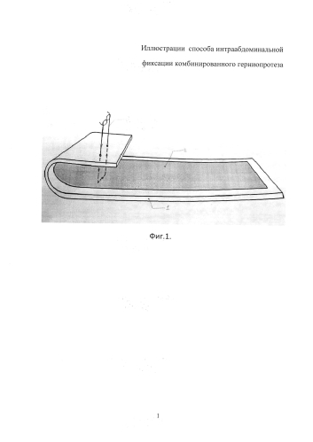 Способ фиксации комбинированного герниопротеза (патент 2591646)