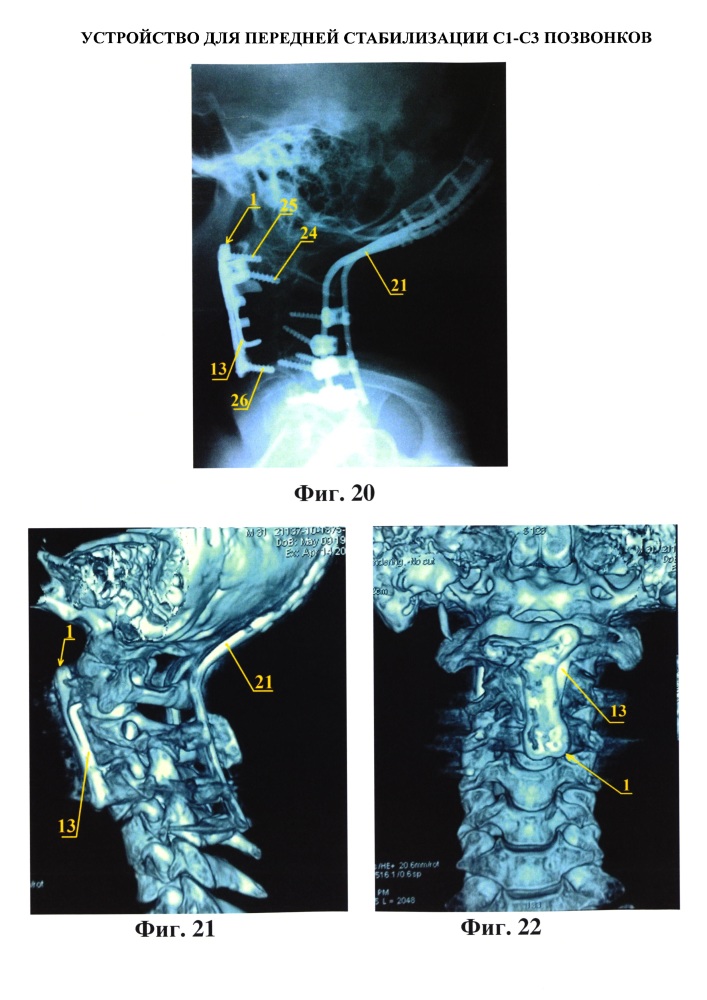 Устройство для передней стабилизации с1-с3 позвонков (патент 2615901)