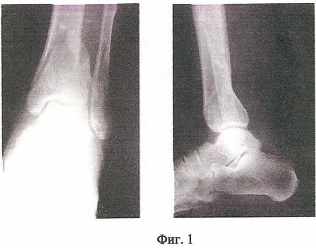 Способ консервативного лечения переломов костей голени (патент 2465858)