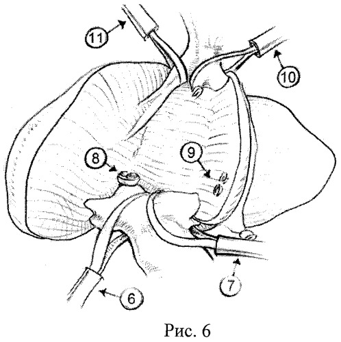 Способ анатомической резекции iv, v, viii сегментов печени (патент 2444311)