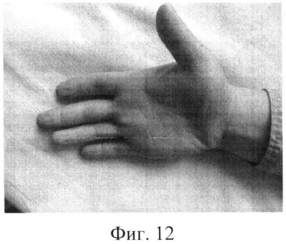 Способ лечения застарелых повреждений сухожилий (патент 2524611)