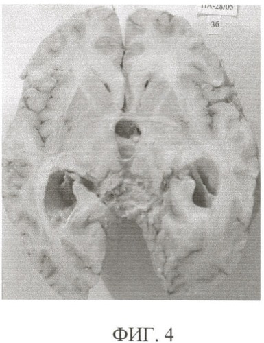 Способ комплексной посмертной патоморфологической диагностики заболеваний головного мозга (патент 2355311)
