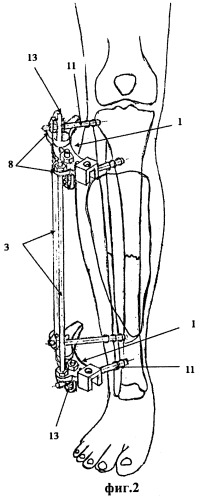 Аппарат для лечения больных с сочетанными повреждениями голени и стопы (патент 2476181)