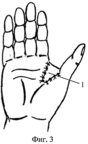 Способ устранения тяжелой рубцовой приводящей контрактуры первого луча кисти (патент 2398541)