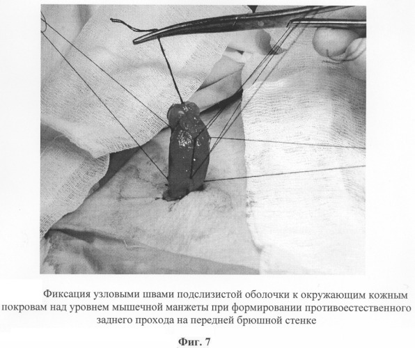 Способ восстановления сосудистого механизма держания при формировании искусственного заднего прохода (патент 2292846)