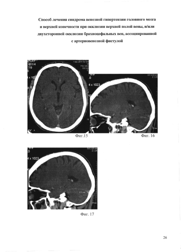 Способ лечения синдрома венозной гипертензии головного мозга и верхней конечности при окклюзии верхней полой вены и/или двусторонней окклюзии брахиоцефальных вен, ассоциированной с артериовенозной фистулой (патент 2573802)