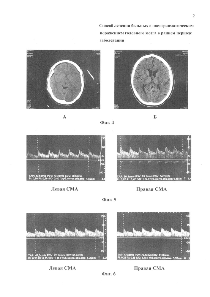 Способ лечения больных с посттравматическим поражением головного мозга в раннем периоде заболевания (патент 2666121)