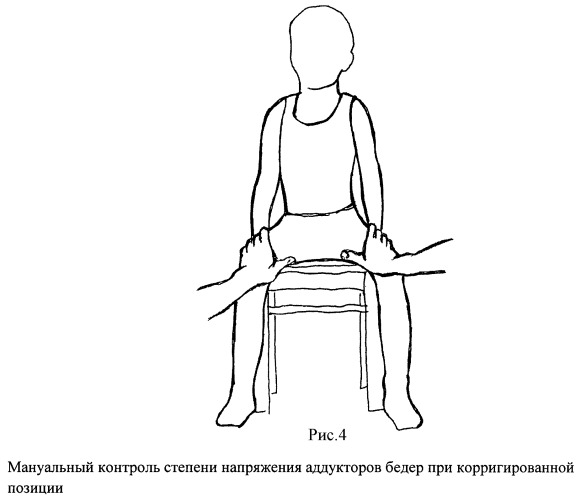 Способ лечения подвывиха бедра и аддукторного синдрома у детей (патент 2448672)