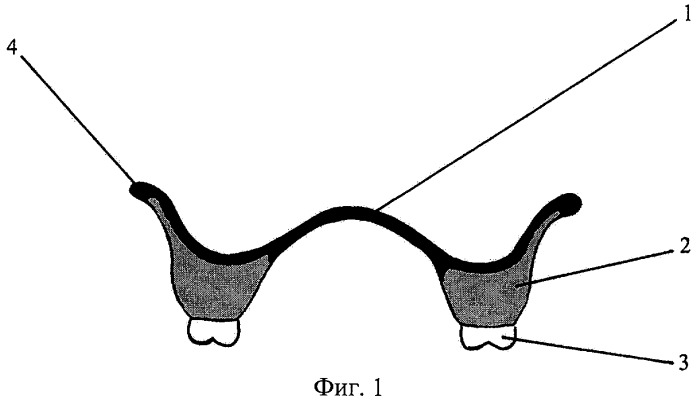 Полный съемный зубной протез верхней челюсти (патент 2270636)