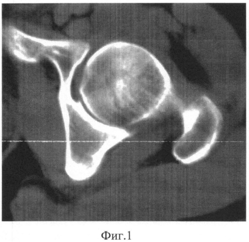 Способ определения истинного угла горизонтальной инклинации в тазобедренных суставах по данным магнитно-резонансного исследования или компьютерной томографии (патент 2547782)