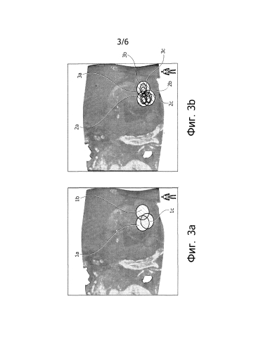 Планирование абляционного лечения и устройство (патент 2581714)