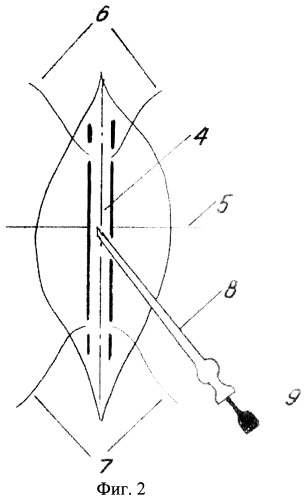 Способ катетеризации лучевой артерии (патент 2290214)