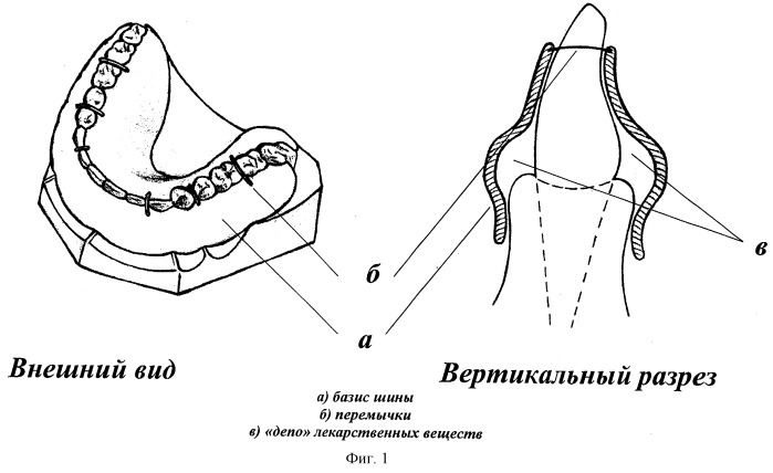 Способ изготовления лечебно-профилактической зубодесневой шины (патент 2249441)