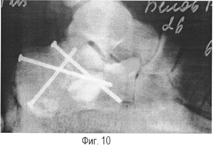 Способ оперативного лечения закрытых оскольчатых языкообразных переломов пяточной кости (патент 2520800)
