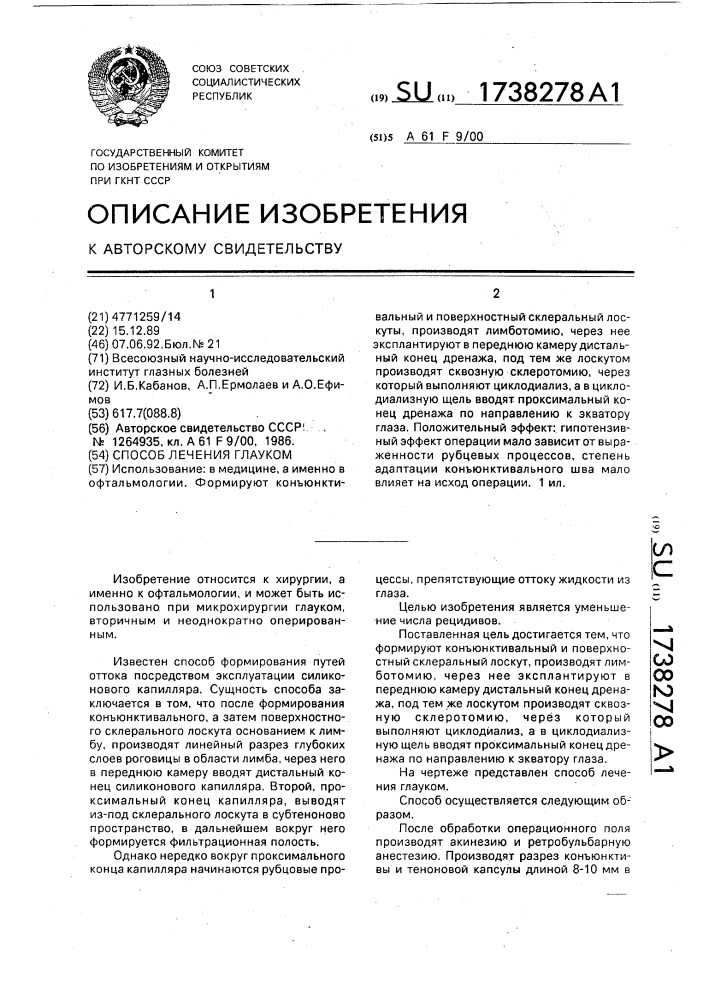 Способ лечения глауком (патент 1738278)