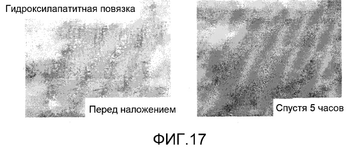 Повязка для лечения кожных заболеваний и облегчения симптомов кожных болезней, вызывающих экссудацию белков крови (патент 2524628)