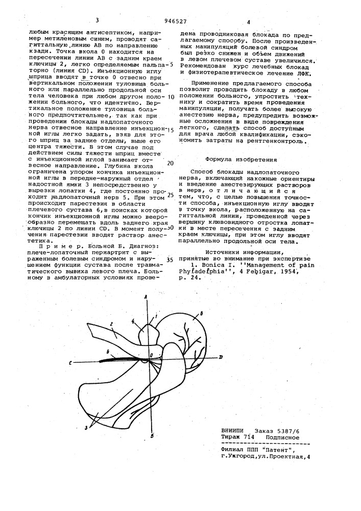 Способ блокады надлопаточного нерва по а.я.гришко и в.а.родичкину (патент 946527)