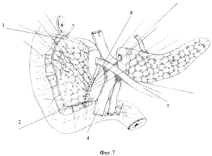 Способ хирургического лечения хронического панкреатита (патент 2421158)