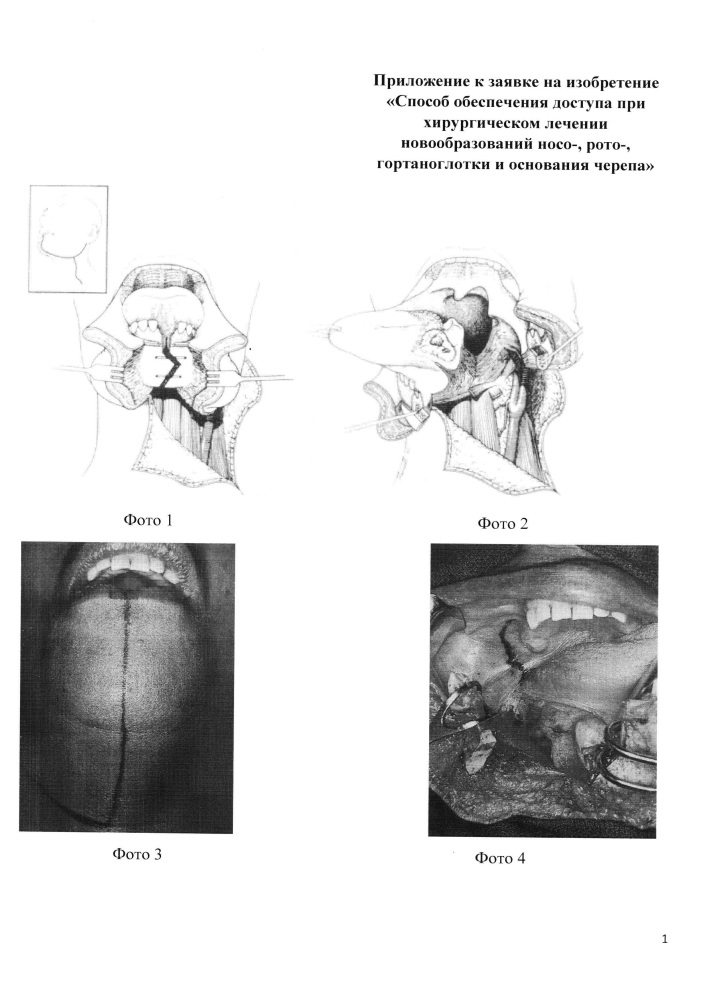 Способ обеспечения доступа при хирургическом лечении новообразований носо-, рото-, гортаноглотки и основания черепа (патент 2664630)