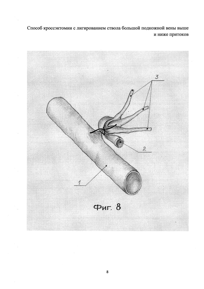 Способ кроссэктомии с лигированием ствола большой подкожной вены выше и ниже притоков (патент 2607919)