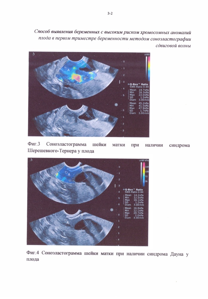 Способ отбора беременных женщин для проведения инвазивной диагностики хромосомных аномалий плода в первом триместре беременности методом соноэластографии сдвиговой волны (патент 2629236)