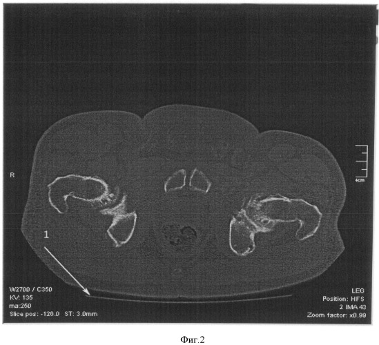 Способ оценки положения проксимального отдела бедренной кости (патент 2493774)
