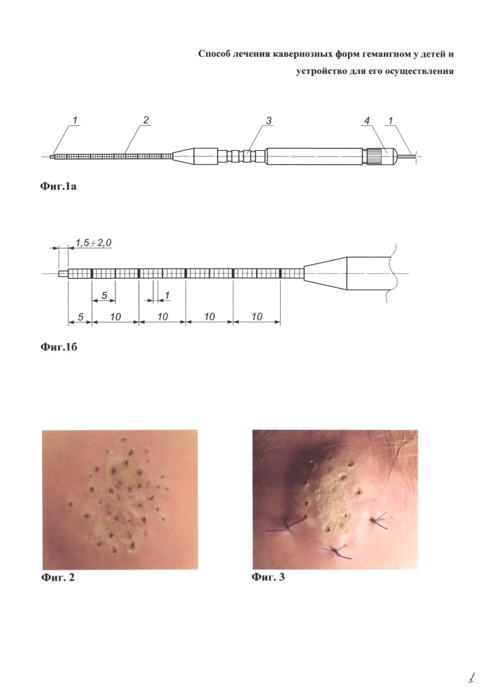 Способ лечения кавернозных форм гемангиом у детей (патент 2629802)