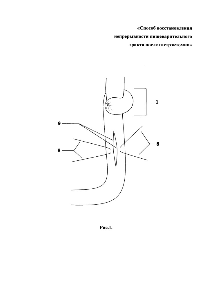 Способ восстановления непрерывности пищеварительного тракта после гастрэктомии (патент 2655980)