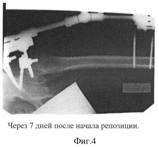 Способ лечения юношеского эпифизиолиза головки бедренной кости у детей (патент 2422110)