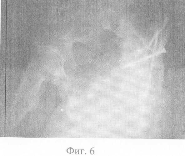 Способ закрытого остеосинтеза переломов вертлужной впадины (патент 2327427)
