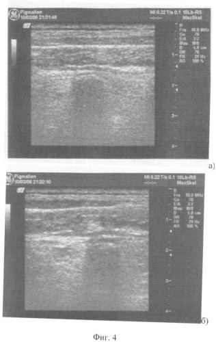 Способ диагностики структурных изменений в паравертебральных мягких тканях спины при компрессионных переломах позвонков на уровне грудного отдела позвоночника (патент 2330613)