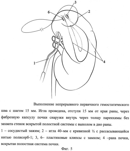 Способ ушивания раны почки при лапароскопическом органосохраняющем лечении рака почки в условиях тепловой ишемии (патент 2532897)
