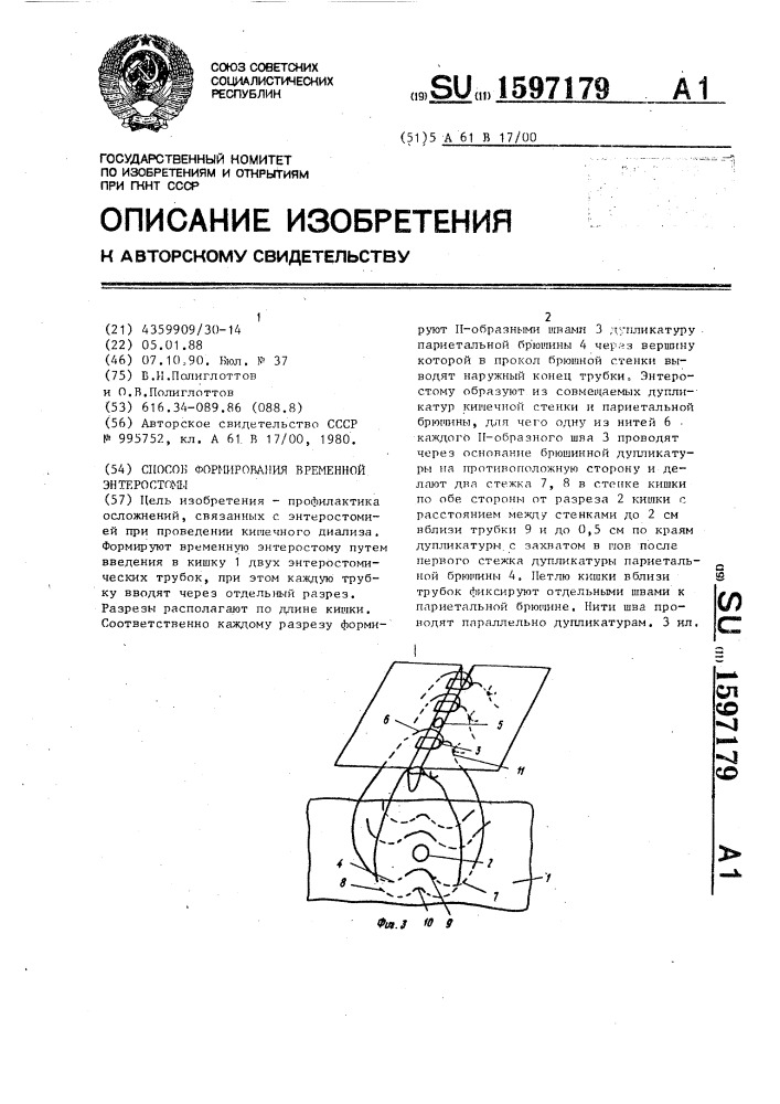 Способ формирования временной энтеростомы (патент 1597179)