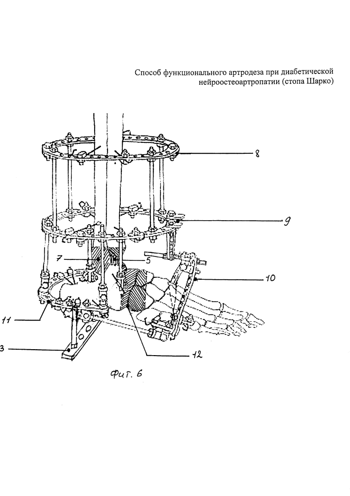 Способ функционального артродеза при диабетической нейроостеоартропатии (стопа шарко) (патент 2604383)