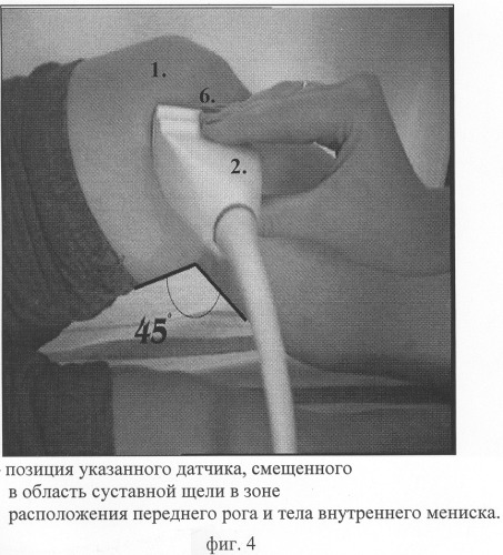 Способ комплексной ультразвуковой диагностики повреждения внутреннего мениска коленного сустава в области тела и переднего рога (патент 2305493)