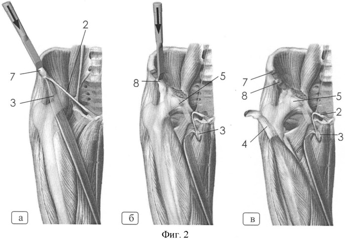 Способ чрескостного доступа к вертлужной впадине (патент 2392891)