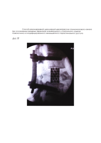Способ малоинвазивной циркулярной декомпрессии спинномозгового канала при осложненных взрывных переломах нижнегрудного и поясничного отделов позвоночника из модифицированного межмышечного параспинального доступа (патент 2592779)