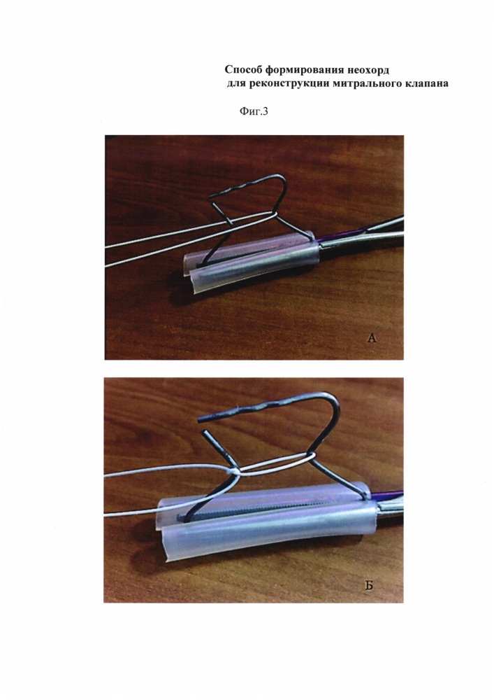 Способ формирования неохорд для реконструкции митрального клапана (патент 2629613)