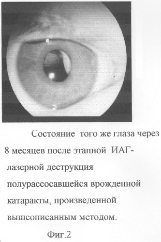 Способ лечения полурассосавшейся врожденной катаракты у детей при синдроме первичного персистирующего гиперпластического стекловидного тела (патент 2282424)