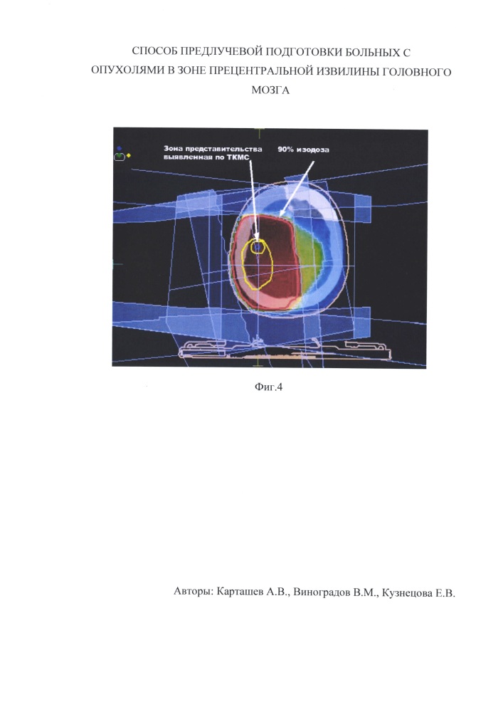 Способ предлучевой подготовки больных с опухолями в зоне прецентральной извилины головного мозга (патент 2632539)