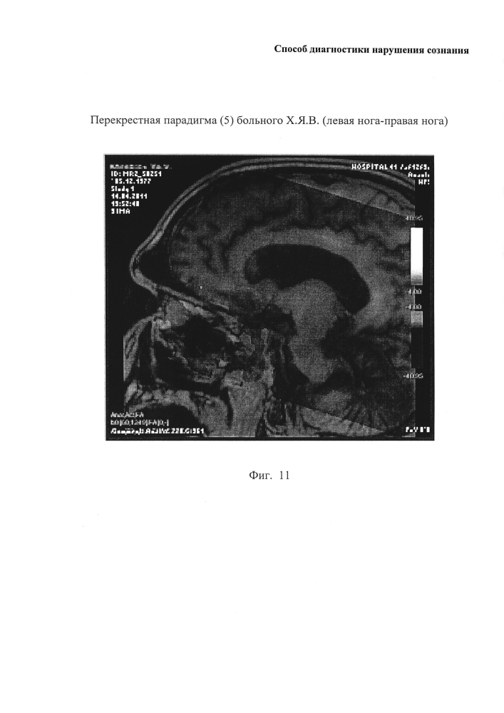 Способ диагностики нарушения сознания (патент 2596049)