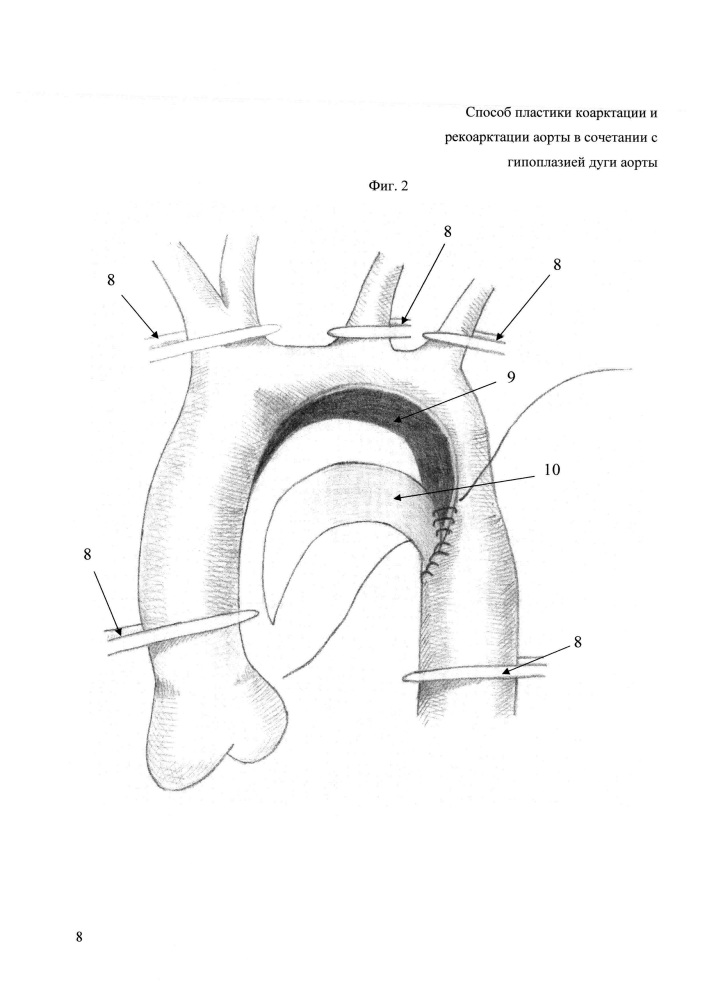 Способ пластики коарктации и рекоарктации аорты в сочетании с гипоплазией дуги аорты (патент 2621953)
