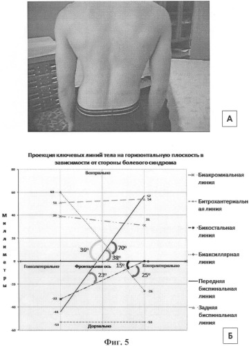 Способ диагностики статических нарушений скелета у больных с вертеброгенными болевыми синдромами (патент 2386392)