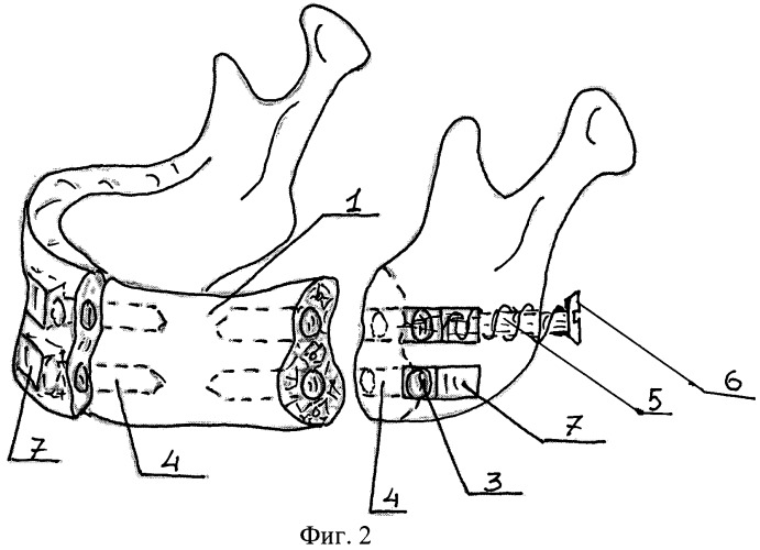 Имплантат для замещения дефектов нижней челюсти (патент 2469682)