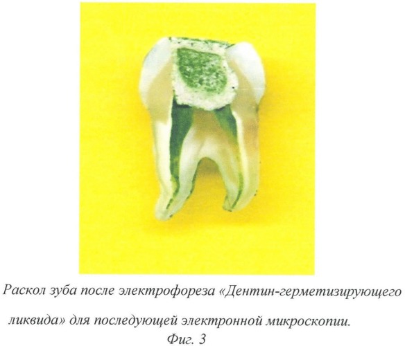Способ эндодонтического наноимпрегнационного лечения пульпита, апикального и краевого периодонтита зубов (патент 2481803)