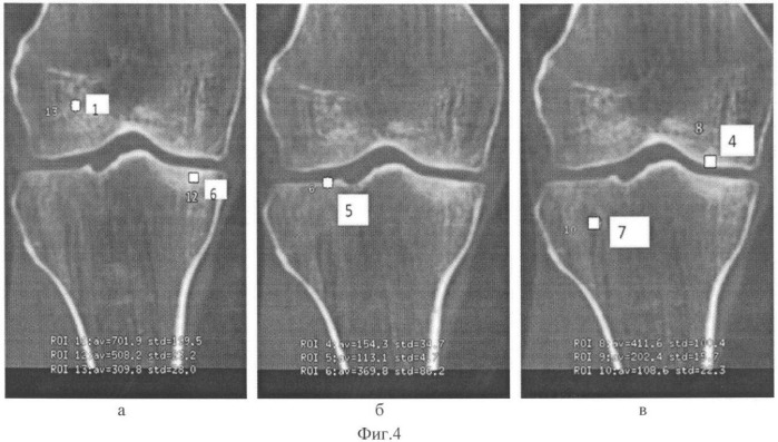 Способ определения степени изменения губчатой кости при деформирующем артрозе коленного сустава (патент 2487669)