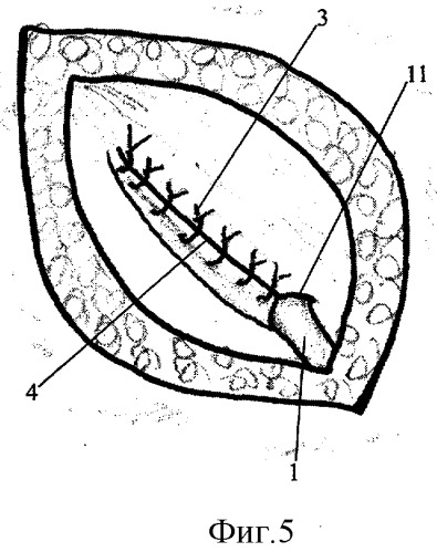 Способ пластики пахового канала с использованием пирамидальной мышцы (патент 2295299)