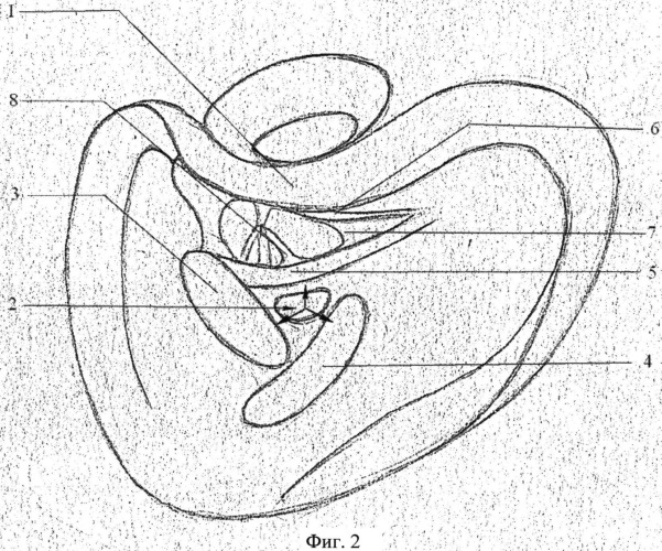 Способ хирургической санации тимпанального синуса (патент 2545427)